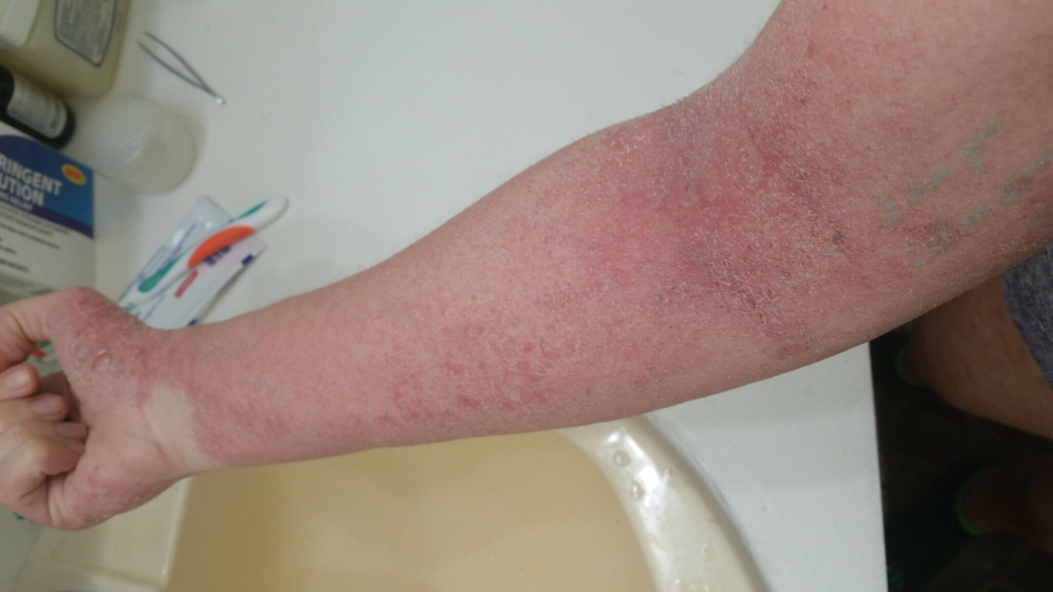 What to Do if You Get Topical Steroid Withdrawal - Like Success